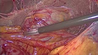 Difficult laparoscopic cholecystectomy LC  3portapproach [upl. by Eirrok]