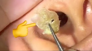 EARWAX IS EASILY REMOVED WITHOUT RUBING [upl. by Wheeler567]