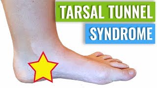 Tarsal Tunnel Syndrome Treatment amp Diagnosis [upl. by Suitangi]