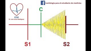 Soplo del prolapso valvular mitral [upl. by Rellek272]