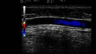 Phlebology Biosound Esaote MyLab 25 Proximal GSV with Reflux [upl. by Rafi]