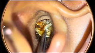 ASMR Ear wax removal satisfying asmr [upl. by Vidal]