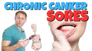 Dealing with Chronic Canker Sores [upl. by Nicolle431]