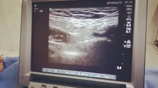 US guided genitofemoral nerve block [upl. by Azelea]