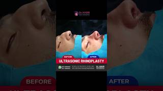 Transformative Rhinoplasty Before and After  Expert Nose Job Results [upl. by Drahsir]