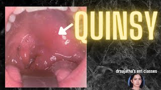 168Peritonsillar abscess Quinsy sorethroat tonsillitis abscess [upl. by Shanly]