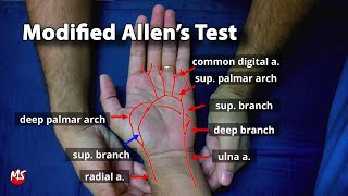 Modified Allens test [upl. by Hanforrd]