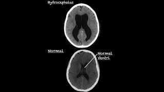 Hydrocephalus CT scan  Diagnosis of hydrocephalus  Normal Pressure Hydrocephalus Radiology [upl. by Sonaj57]