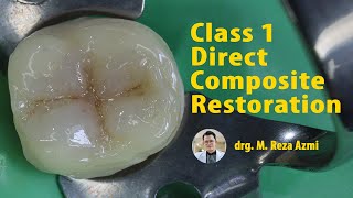 Class I Direct Composite Restoration  Operative Dentistry Polofil NHT Nano Hybrid Composite [upl. by Nashom]