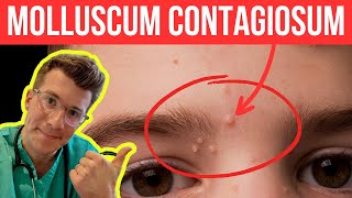 Doctor explains Molloscum Contagiosum viral skin infection  Causes symptoms and treatment [upl. by Asher950]