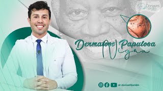 Como tratar a DERMATOSE PAPULOSA NIGRA  Dr Donizetti Jardim [upl. by Tracy307]