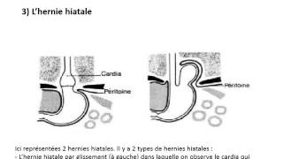 SEMIOLOGIE CHIRURGICALE Sémiologie œsophagienne et gastrique [upl. by Nahsyar641]