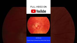 CMV Retinitis Fundoscopy [upl. by Neelra]