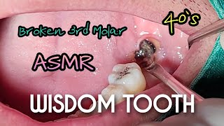 ASMR Severely Broken Decayed Wisdom Tooth Extraction 4k [upl. by Llerdnam969]