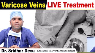 LIVE 🔴 Laser Treatment For Varicose Veins in Legs  Varicose Vein Treatment Procedure  Dr Devu [upl. by Ahsemit]