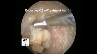 Management of external auditory canal cholesteatoma under anesthesia 11 min [upl. by Esther406]