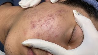 ACNE TREATMENT VU QUYNH MI  Blackheads On Boy Face 2024FULL [upl. by Inalaek488]