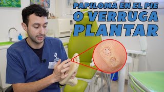 Papiloma en el pie o verruga plantar  Tipología tratamiento y prevención [upl. by Alejoa]