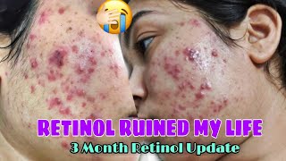 RETINOL SIDE EFFECTS MY 3 MONTH ACNE JOURNEY RETINOL BEFORE amp AFTERRETINOL JOURNEY [upl. by Ardnoid]