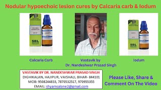 Nodular hypoechoic lesion cures by Calcaria carb amp Iodum [upl. by Yancy984]