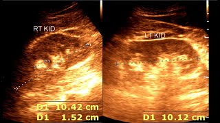 Angiomyolipoma  Renal Mass  Renal Tumor [upl. by Osher]