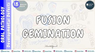 Fusion  Gemination  How to differentiate between fusion and gemination  Dr Paridhi Agrawal [upl. by Nayra745]