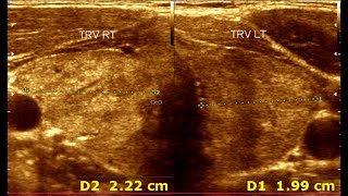 Understanding Ultrasonographic Features of Chronic Thyroiditis [upl. by Pegeen]