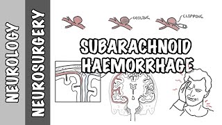 Subarachnoid Haemorrhage  pathophysiology complications and management [upl. by Cesare]