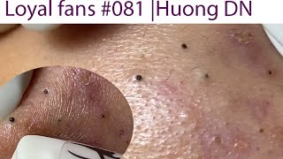 Acne Treatment Huong Da Nang 081  Loyal fans [upl. by Yroc268]