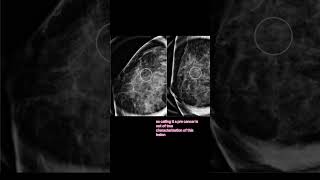 Busting breast cancer myths all atypical ductal hyperplasia becomes cancer breastcancerawareness [upl. by Sivartal]