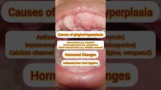 gingival Hyperplasia etiology teeth gumgrowthtreatment causes thecuriousmindgingival [upl. by Enelrats]