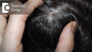 How can one manage scabs on scalp with itching white flakes amp dryness  Dr Rashmi Ravindra [upl. by Erodoeht750]