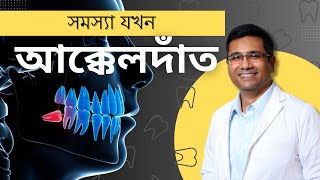 আক্কেলদাঁত এর সমস্যা ও সমাধান ২০২৪  Wisdom Teeth Pain [upl. by Nayarb]