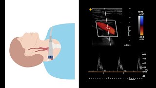 Scanning the extracranial arteries with ultrasound [upl. by Khudari250]