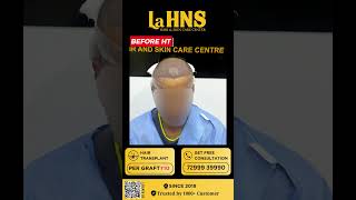 quotRegain Your Confidence Regrow Your Hairquot  Lahns  Hair transplant  Coimbatore [upl. by Barn187]