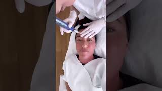 SkinPen microneedling behandeling in Amsterdam met Naomi van As [upl. by Flam]