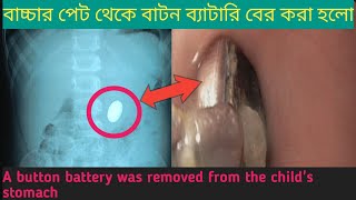 বাচ্চার পেট থেকে বাটন ব্যাটারি বের করা হলো A button battery was removed from the childs stomach [upl. by Petrine]