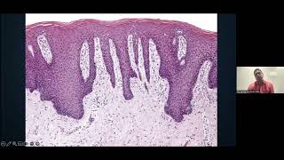 Spongiotic and Psoriasiform dermatoses Quiz Based Teaching [upl. by Ille]