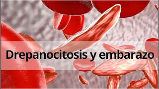 Embarazo de alto riesgo Drepanocitosis y embarazo Presentación de un caso clínico [upl. by Anaderol]