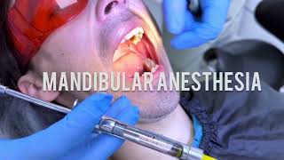 Techniques for Mandibular Anaesthesia  VaziraniAkinosi Mandibular Block Technique dentist dental [upl. by Sinegra]