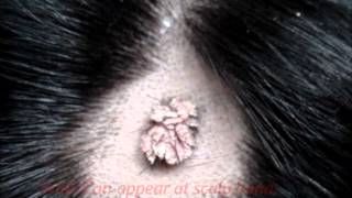 wart verruca  over scalp in a young male [upl. by Aloise]