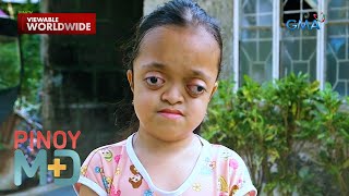 Ano ang ‘Crouzon syndrome’ at sino ang posibleng dapuan nito  Pinoy MD [upl. by Egidio]