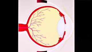 Diabetische Retinopathie [upl. by Notlil]