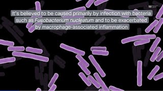 The root of the problem F nucleatum triggers cell death in apical periodontitis via ZBP1 [upl. by Babbette956]