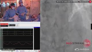 Multivessel PCI in STEMI Using RA [upl. by Perl]