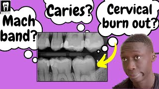 Caries Vs Cervical burnout Vs Mach band effect  Interpretation of Dental Caries [upl. by Ahgiel]