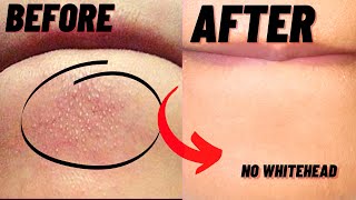 How To Remove Whiteheads And Blackheads From Chin At Home [upl. by Alden]