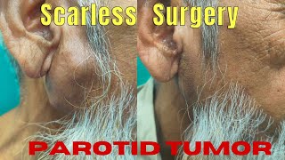 Scarless removal of parotid Tumor Surgery of pleomorphic adenoma in Ranchi by Dr Pankaj Kumar [upl. by Eladnar]