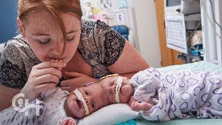 Conjoined Twins Abby and Erin Delaney A Year in the Life [upl. by Alameda]