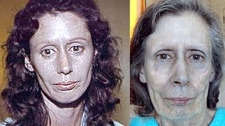 Womans Skin Turns Silver For 60 Years  Rosemary Jacobs [upl. by Noswad435]